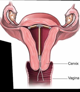 Copper IUD insertion Diagram